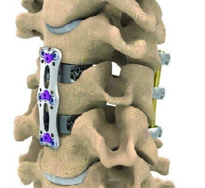 NuVasive Unveils C360 Portfolio, Including Thinnest Cervical Plate on the Market